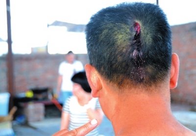 崔先生頭部受傷。京華時(shí)報(bào)記者趙思衡攝/視頻