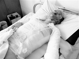 周小姐的頭、頸、軀干、四肢均被燒傷，其中面部燒傷最為嚴重。