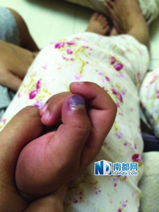 小逸手指被夾傷。