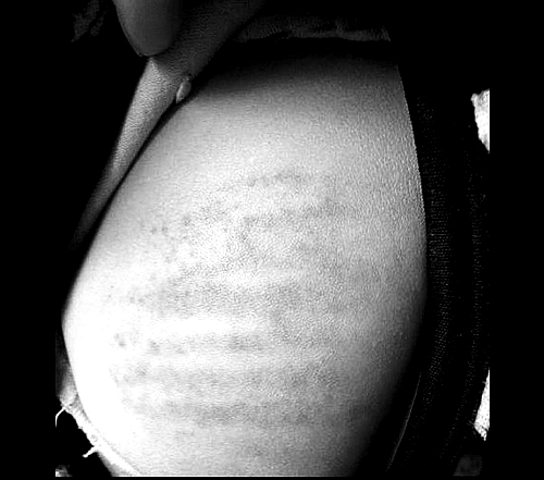 沒(méi)帶作業(yè)本 信陽(yáng)潢川4歲娃兒遭老師輪番鞭打