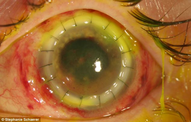 恐怖慎入！隱形眼鏡致英女子摘除眼球