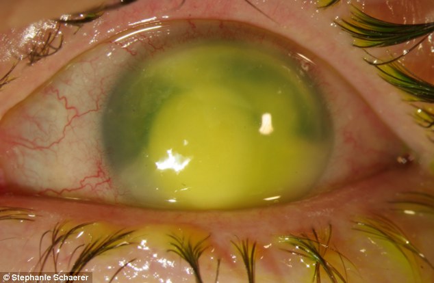 恐怖慎入！隱形眼鏡致英女子摘除眼球