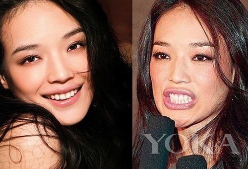 牙齒凸出，口輪肌過于松弛