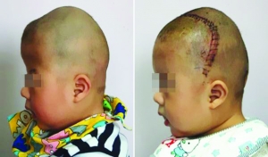 術(shù)前（左），術(shù)后（右）