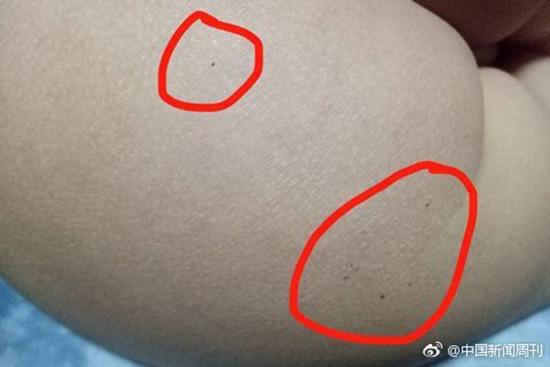 據(jù)多名紅黃藍(新天地分園)家長反映，孩子腿部、屁股、腋下出現(xiàn)針眼。