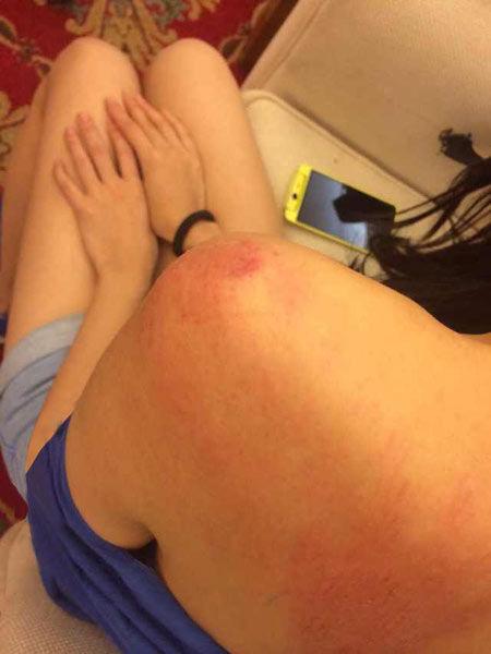 “跑男”真的很拼！baby朋友圈曬后背紅腫照