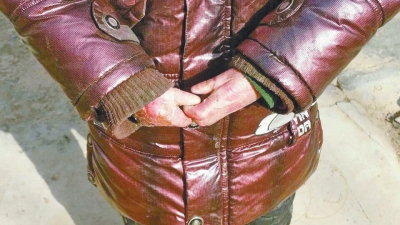 長期受損的手指，已經(jīng)長在了一起。