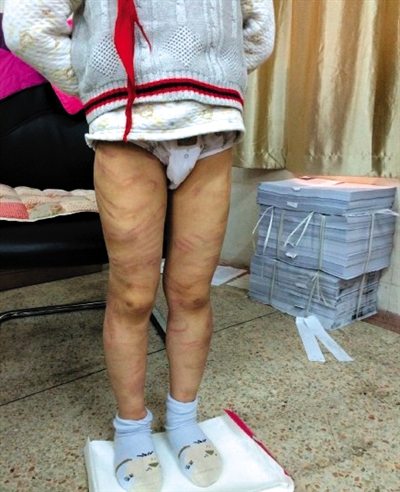 4月3日晚，微博網(wǎng)友“@朝廷半日閑”發(fā)圖文微博展示男童被虐待的慘狀。 微博截圖