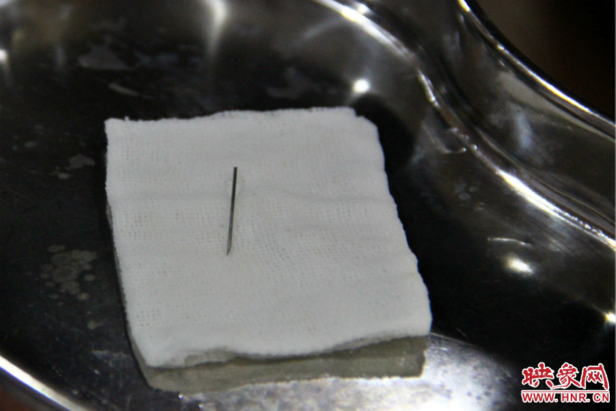 上午11點(diǎn)30分許，小龍腦中鋼針已經(jīng)成功取出。