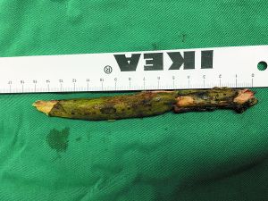 插入男子腦內(nèi)的樹枝。