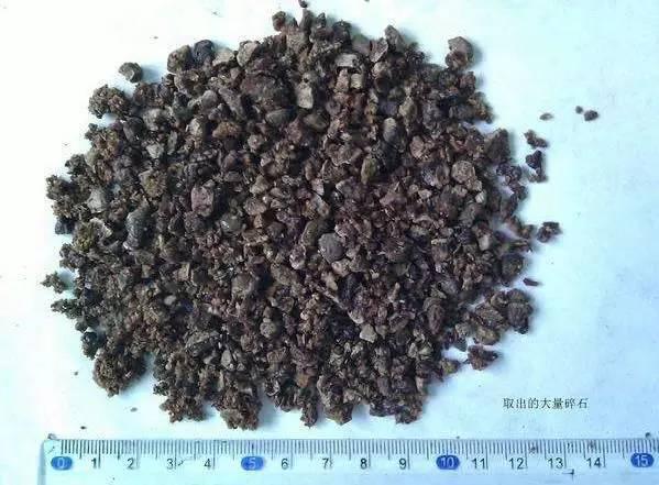 55歲大爺因愛(ài)吃豆腐 體內(nèi)取出420顆結(jié)石